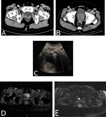 Case Report: Analysis of four cases of metastatic bladder masses after radical prostatectomy